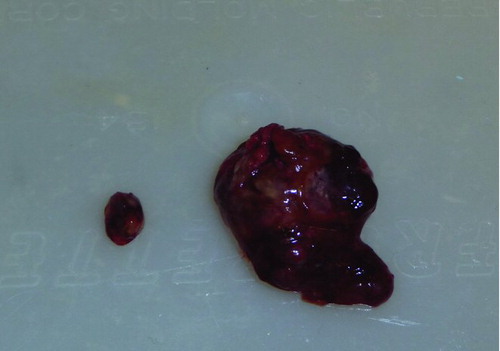 Figure 5  Average sized tumor (0.12% of final body weight) from a walnut-fed mouse and the largest tumor (1.24%) from a control mouse at the conclusion of the study. In comparison, the maximal diameter of the small tumor in this figure is 6 mm.