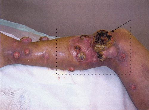 Figure 1. A patient with multiple large melanoma lesions on the right leg. The box indicates the radiotherapy target volume. The arrow points to the entrance point of the invasive thermometry probe during treatment 3.