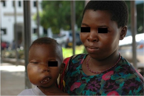 Figure 1 Typical case of endemic BL involving the facial bones in an African child (picture courtesy of RB, taken at Ocean Road Cancer Institute, Dar-es-Salaam, Tanzania, 2007).