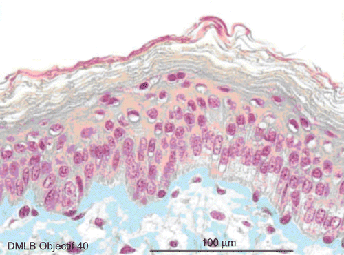 Figure 6.  Skin histological aspect at 3 min after a 20-sec exposure to 30 µL of 70% hydrofluoric acid (HF). Lesions of four to five epidermis cellular layers were characterized by numerous cells with moderately pyknotic nuclei and edema surrounding the nuclei. At the base of the stratum corneum and in the basal epidermis layer, cells showed characteristic cytoplasmic alterations. In the papillary dermis, the cellular structures were slightly pyknotic. The reticular dermis remained normal.
