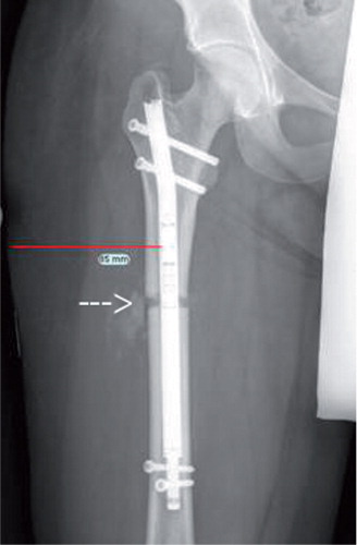 Figure 3. The application level depends on the positioning of the magnet, which can be identified in relation to the osteotomy level on the radiograph (see arrow).