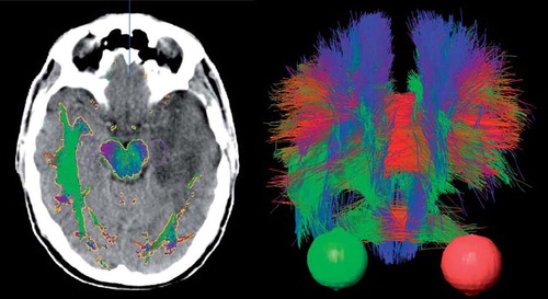 Figure 2. Left: transversal CT image with overlaid tractography structure in gold. The hippocampi and brainstem are displayed in purple and green, respectively. Right: a 3D fiber tract structure seen anteriorly with eyes in red and green for the same patient. Fibers are displayed in red, green and blue in the images. The color coding is by convention red for commissural (transversal) tracts, blue for fibers running superoinferiorly and green for fibers running in ventralodorsaly. The fibers were disrupted and displaced by the tumor, as indicated by the lack of symmetry in both images.