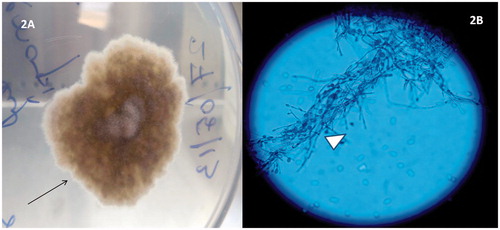 Figure 2. (A) Sabouraud dextrose agar showing growth of Scedosporium apiospermum (black arrow). (B) Lactophenol blue mount showing fungal filaments characteristic of Scedosporium apiospermum (white arrowhead).
