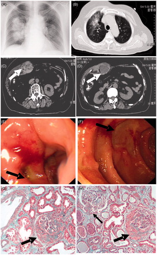 Figure 1. Chest X-ray (A) and CT (B) revealed large areas of ground glass opacity in the middle and lower lung fields. Abdominal CT (C and D) showed an extensive, irregular low-density mass in the right rectus muscle (white arrow). Gastrointestinal (GI) endoscopy demonstrated two duodenal ulcers around 2 cm diameter. Some of the mucosa between the ulcers is reddish and edematous. The border of the ulcer is unclear and covered with white coating (E). Another ulcer is square and clears (F). Renal biopsy showed two large fibrocellular crescent (black arrow) and a small cellular crescent (black thin arrow) in the renal glomeruli (G and H). Protein cast were presented with lymphomonocyte interstitial infiltration around glomeruli (H). Periodic acid-Schiff stain, 200×.