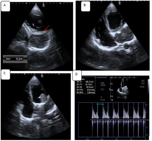 Figure 3 (A) shows the narrow neck of the pseudo-aneurysm with diameter of 12mm (red arrow). (B) showing the pseudo-aneurysm as a mass appearing parallel to the left atrium in this view. (C) longitudinal mass protruding from the pseudo-aneurysm towards the left ventricle. (D) Continues wave Doppler assessment of the prosthetic valve.