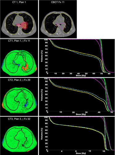 Figure 2. The top left panel shows the planning CT for the 1st treatment plan of case B with delineations of the lungs (yellow), esophagus (white) and CTVs (purple). The 95% isodose is also indicated (red color-wash). Next to the planning CT a re-delineated CBCT slice of fraction 11 is shown. The lower panels show the γ evaluations for fractions 11, 29 and 32, respectively. Voxels failing the (3%, 3 mm) criteria show up in blue (under dosage) and red (overdosage). The lungs are drawn in black, the dashed lines are the CBCT delineations and the solid lines are the planning CT delineations. Next to the γ plots are the different DVHs for the CTV (planned: green; measured: purple) and the esophagus (planned: yellow; measured: blue).