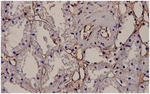 Figure 3. Interstitial capillary and arteriolar endothelium positive for TGFβ stain. TGFβ stain LSAB2-DAB × 200.