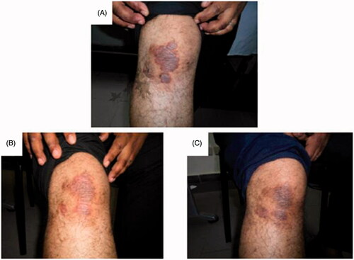 Figure 4. Assessment of the right knee psoriatic lesion treated with MTX microemulsion formulation/fractional erbium:YAG laser along the treatment course for patient 2: (A) before treatment, (B) after 3 weeks of treatment and (C) after 8 weeks of treatment.