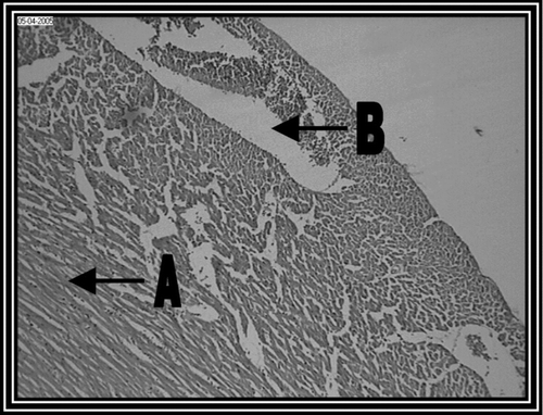 Figure 2.  Pathogenic control group (i.e., group II) rat heart section, showing, (A) Marked inflammatory infiltrate with (B) edema (10 x).