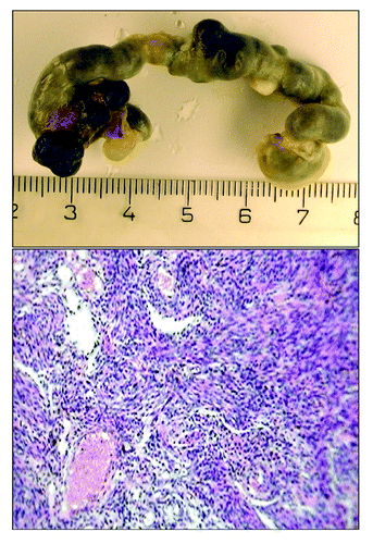 Figure 1. Macro- and microphotograph of uterine sarcoma in 129/Sv mice exposed to constant light regimen (H and E, ×320).