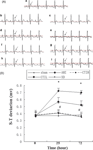 Figure 2.  Effect of CTI on S-T segment deviation (mv) of acute myocardial ischemia (AMI) rats. (A) Representative chants of ECG. Differences in the ECG patterns were observed between the groups at 1 and 48 h after isoproterenol-induced AMI model in rats. As the arrows show, the S-T segment and T wave of rats were elevated significantly and were inhibited by CTI and XD. (a), (b), (c), (d), (e), (f), (g), (h) and (i) correspond to groups: (a) control group; (b) model group at 1 h after AMI model established; (c) model group at 48 h after AMI model established; (d) CTIH group at 1 h after AMI model established; (e) CTIH group at 48 h after AMI model established; (f) CTIL group at 1 h after AMI model established; (g) CTIL group at 48 h after AMI model established; (h) XD group at 1 h after AMI model established; (i) XD group at 48 h after AMI model established. The paper speed was 100 mm/s. (B) Effect of CTI on S-T segment deviation (mv) of acute myocardial ischemia (AMI) rats. Results are mean ± SD (n = 10). Compared with sham: *p < 0.05. Compared with AMI: #p < 0.05.