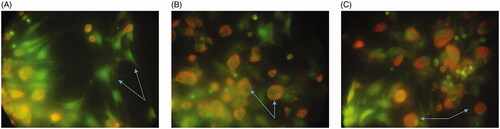 Figure 5. The assessment of MCF-7 apoptosis by propidium iodide/acridine orange staining. The green cells with diffused chromatin are viable (A), the cells with condensed chromatin are apoptotic (B) and the red cells with no condensed chromatin are necrotic (C).