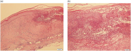 Figure 2. The biopsy of the skin lesion. Neutrophil infiltration, fibrous tissue proliferation below and around the ulcer, fibrinoid degeneration of some vascular walls, and a few lymphocytes and eosinophils around the blood vessels. (a) 40×, (b) 200×.