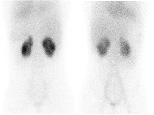 Figure 1. DMSA nuclear scan showing mildly lobulated contour with cortical scarring in upper poles of both kidneys.
