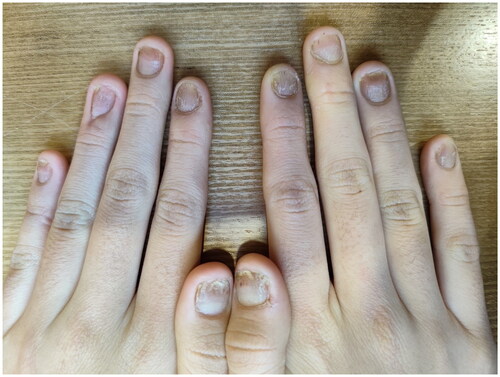 Figure 4. Week 16, nearly resolution of nails psoriasis (NAPSI = 15; DLQI = 10).