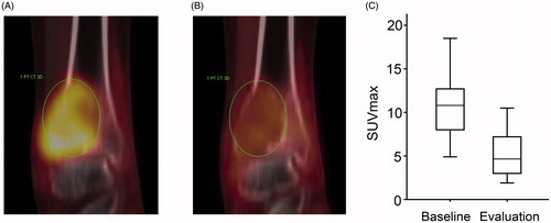 Figure 1. Coronal 18F-FDG PET/CT images from a patient with a tumor in the distal tibial bone at baseline (A) and at first evaluation after 4 weeks (B). (C) Boxplot showing SUVmax at baseline and first evaluation for all patients.