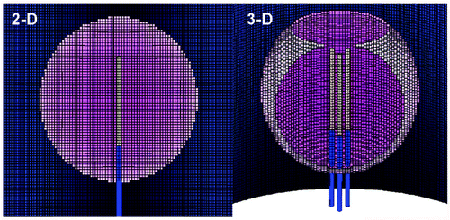 Figure 1. Finite element model meshes. This is an illustrative representation of both the (A) 2D finite element model used for simulating a 3 cm single internally cooled electrode in a 4 cm tumor (as denoted by the purple), and (B) the 3D finite element model used to simulate a 2.5 cm cluster electrode in a 4 cm tumor.