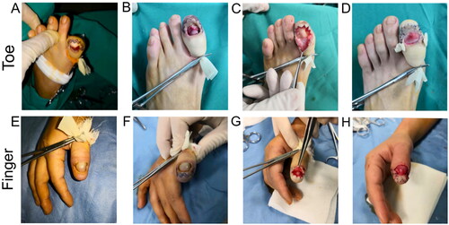 Figure 3. Application of the continuous W-Shaped incisions: (A, B) The incision is made on the toe pulp about 2–3 millimeters away from the nail bed. (C) The nail bed flap is carefully dissected along the design line and appropriately trimmed based on tension and blood circulation. The remaining nail bed flap is stretched outward, and the longitudinal axis is adjusted by removing soft tissue from the fingertip. (D) Finally, the incision is sutured to push the nail bed. (E–H) Continuous W-shaped incision nail bed surgery was conducted on the patient’s thumb.