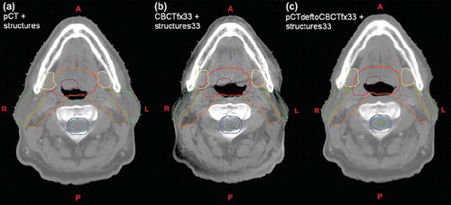 Figure 2. Three corresponding axial slices showing (a) planning CT with structures; (b) cone-beam CT acquired at fraction 33 with propagated structures from planning CT after deformable image registration; (c) planning CT deformed to anatomy of cone-beam CT acquired at fraction 33. Structures shown are clinical target volume 1 (CTV1) (brown); CTV2 (red); CTV3 (orange); spinal cord (cyan) with planning risk volume (blue); parotid (green) and submandibular (yellow) glands.