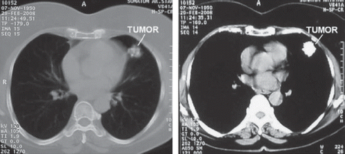 Figure 2. Chest CT scan. A computed tomogram showed a 2.1 cm heterogeneous calcified mass at the lingula of the left lung.