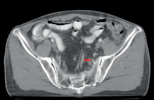 Figure 2. Superior rectal vein (red arrow).