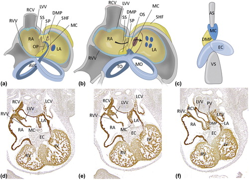 Figure 2. Atrial septation. a: Early developmental stage. Atrial septation starts with formation of a muscular septum primum (SP), that grows out from the roof of the atrium towards the AV canal (AVC). The lower rim of the SP consists of mesenchymal tissue, the mesenchymal cap (MC, indicated in dark blue) that is continuous with the endocardial cushions in the AV canal (light blue). Initially, the lower part of the SP will not connect to the tissues in the AV canal, leaving an opening, the ostium primum (OP). b: During further development, the OP will be closed by fusion of the endocardial cushion with the mesenchymal cap, as well as with second heart field (SHF) mesenchyme protruding into the heart at the base of the atrial septum. This protrusion is referred to as dorsal mesenchymal protrusion (DMP). Meanwhile, the ostium secundum (OS) in the muscular SP has developed by a process of apoptosis. The septum secundum (SS) is formed at the right side of the SP by an infolding of the roof of the atrium, but will never entirely reach the AVC. The free rim of the septum secundum forms the limbus of the foramen ovale. During the entire fetal phase the foramen ovale (consisting of the opening between the lower rim (limbus) of the SS and the OS secundum) will allow shunting of blood from the right atrium (RA) to the left atrium (LA) (arrow in panel b). c: Schematic overview of the three structures responsible for proper closure of the OP during development: the atrioventricular endocardial cushions (EC, light blue), the mesenchymal cap (MC, dark blue), and the dorsal mesenchymal protrusion (DMP, yellow). d–f: Transverse sections stained with the myocardial marker myosin light chain 2a (MLC2a) of murine embryonic wild-type hearts, stage E12.5. d. is the most superior and f. the most inferior section. Elements contributing to normal atrial septation are indicated. (AS = atrial septum; LV = left ventricle; LCV = left cardinal vein; LVV = left venous valve; MO = mitral ostium; PV = pulmonary vein; TO = tricuspid ostium; RV = right ventricle; RVC = right cardial vein; RVV = right venous valve; VS = ventricular septum). a and b: modified after (Citation116).