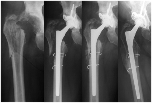 Figure 2. 57-year-old male patient (2-stage exchange, ETO, Wagner SL, ARR). Girdlestone hip (a) due to difficult-to-treat bacteria (small-colony variant of S. aureus), postoperatively (b), and after 3 months (c). Complete remodeling of the proximal femur at 5 years (d).