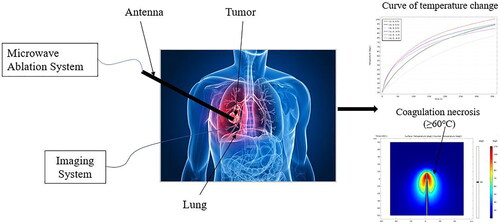 Figure 1. Schematic diagram of MWA treatment of lung tumor.