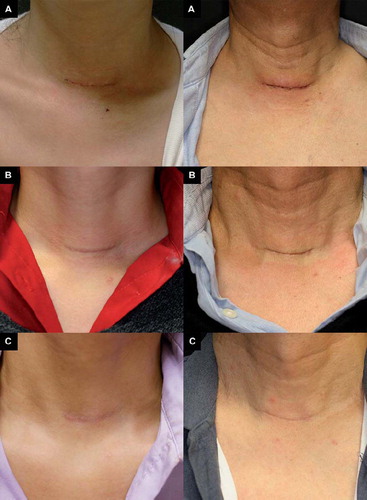 Figure 1. Clinical photographs of the fresh surgical scar at (A) baseline, (B) 1 month after three sessions of PDL, and (C) 1 month after three sessions of EYFL in patient 9 (left) and patient 6 (right).