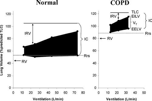 Figure 2 Changes in operating lung volumes are shown as ventilation increases with exercise in COPD (n = 105) and in age-matched normal subjects (n = 25). “Restrictive” constraints on tidal volume (VT, solid area) expansion during exercise are significantly greater in the COPD group from both below (reduced inspiratory capacity [IC]) and above (minimal inspiratory reserve volume [IRV], open area). Other abbreviations:EELV = end-expiratory lung volume; EILV = end-inspiratory lung volume; RV = residual volume; TLC = total lung capacity; VC = vital capacity. From reference 105, with permission.
