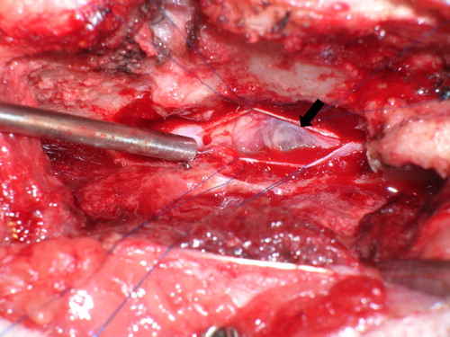 Figure 2. Intraoperative view of the spinal cord in case 1. After durotomy, a grayish white, fluid-filled mass was visualized (arrow).