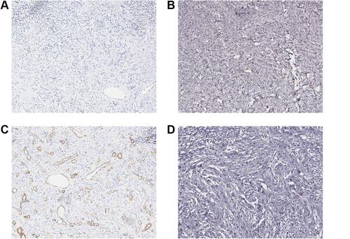 Figure 4 Immunophenotype (IHC with SP method, × 100). (A) Negative expression of MITF; (B) negative expression of HMB-45; (C) negative expression of SMA with surrounding vascular endothelium demonstrating positive internal control; (D) negative expression of P53.
