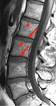Figure 4 Chemical Shift artifact in the spine. At the junction between the vertebrae and the disk, there are a series of light and dark bands (indicated by solid red arrows) [Courtesy Allen D Elster, MRIQuestions.com].Citation22