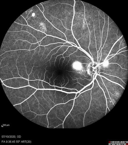 Figure 4 Retinal angiography of a right eye affected by recurrent central serous chorioretinopathy (CSC).
