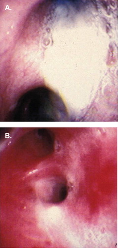 Figure 3. Image on bronchoscopy of the right upper lobe in a patient with cystic fibrosis who had diffuse mucopurulent secretions that later cultured Pseudomonas aeruginosa (A) and underlying lower airway mucosal inflammation after removal of secretions (B).