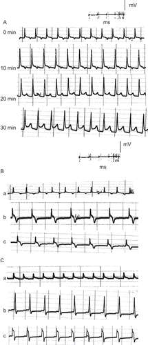 Figure 6.  ECG traces showing (A) the effect of direct perfusion of isolated toad heart with latex solution (0.2 μg/mL) of C. procera on the electrocardiogram of isolated toad heart at different time intervals; (B) the effect of adding atropine (4 μg/mL) after latex application, and (C) the effect of adding verapamil (5 μg/mL) after latex application (a) before treatment, (b) 20 min after treatment, (c) after adding blocker.