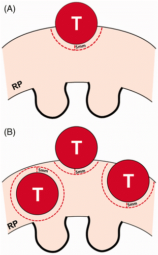 Figure 2. Schematic diagram of a renal tumour and tumour margin according to the number of tumours. (A) An exophytic tumour is projecting 50% out from the renal parenchyma. RP indicates renal parenchyma. (B) There are three tumours consisting of one parenchymal tumour (left) and two exophytic tumours, all the same size as figure A. These exophytic tumours are projecting 70% (middle) and 30% (right) from the parenchyma into the peri-renal space, respectively. Renal tumours in figure B require four times the normal renal tissue for thermal ablation than in figure A.