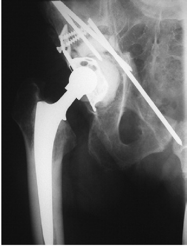 Figure 4. The migrated pin projecting into the pelvic cavity.