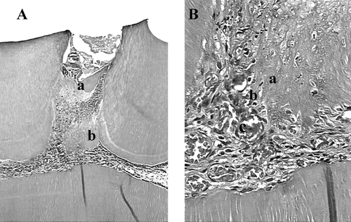 Figure 2 Histologic slide after pulp capping with Ca(OH)2 in teeth of rat after 30 days. (A) (a) pulp exposure (b) mineralized tissue, magnified 10× (B) (a) deeper layer of mineralized tissue, (b) odontoblastes layer reorganization, (c) capillary enhanced, magnified 40× (H&E).