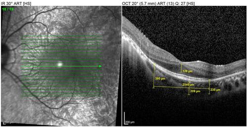 Figure 7 Spectral domain-optical coherence tomography in left eye of retinitis pigmentosa patient. It is possible to observe: an epiretinal membrane between the optic disc and the macula; loss of the photoreceptor layer beyond the fovea; increase of the central nuclear layer.