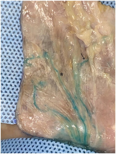 Figure 4. Exploration of superficial peroneal nerve underneath the flap shows the staining of paraneural vessels (asterisk) along the nerve and the neurocutaneous perforator (arrow) linking paraneural vessels and subcutaneous plexus.