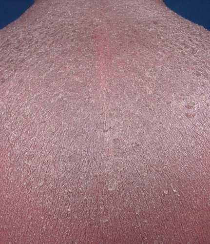Figure 1.  A patient of Africa descent with diffuse erythema and scaling (smoldering ATL).