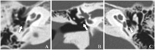 Figure 1. Preoperative high-resolution computed tomography (CT) of the temporal bones in case 1. (A) Axial CT view shows dislocation of the stapes superstructure from the footplate onto the promontory in the right ear. (B) Coronal view shows the inferiorly displaced stapes in the right. Arrows indicate the stapes superstructure. (C) Axial CT view for the normal left ear. Arrowhead indicates the stapes superstructure.