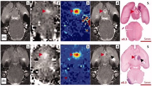Figure 6. Image correlations. (A) Thermal lesion in the healthy brain. (B) Thermal lesion in the brain tumour. The red arrows indicate the region of acoustic energy deposition. The black arrows indicate the tumour location. (1) T2-weighted MRI, (2) MR-ARFI before treatment, (3) MR thermometry map during treatment, (4) T2-weighted MRI after treatment, (5) macroscopic section of whole brain H&E.