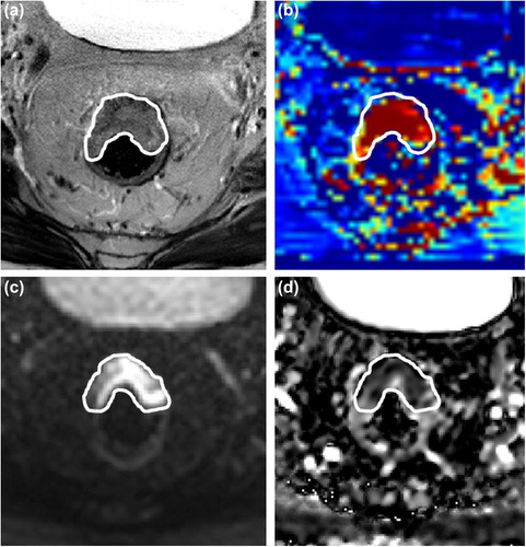 Figure 1. cT3N2 rectal adenocarcinoma in a 60-year-old male patient. T2-weighted imaging (a), Ktrans map (b), b800 image (c) and apparent diffusion coefficient map (d).
