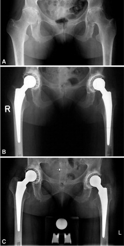 Figure 8. A. A preoperative radiograph of a 29-year-old woman with bilateral secondary osteoarthritis due to Bechterew’s disease. B. The hips after bilateral cemented THA with acetabular impaction bone grafting of a cavitary defect. C. At 17 and 18 years after the reconstruction there was incorporation of the bone graft and no signs of loosening except for an acetabular radiolucent line at the right hip in zone III.