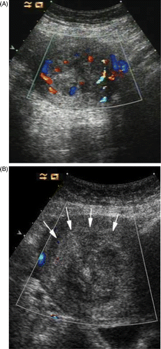 Figure 3. (A) CDFI of myoma before ablation shows the myoma with hyperperfusion. (B) CDFI of ablated myoma at the end of ablation. No residual colour Doppler is demonstrated.