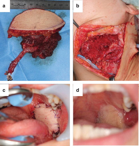 Figure 4. Illustrations showing the reconstruction on patient 2: (a) the anterolateral thigh vastus lateralis musculocutaneous flap. (b) The flap was transferred into the oroparapharyngeal space. The suprathyroid artery and common facial vein were used as the recipient vessels. (c, d) Illustrations showing the oropharynx immediately after surgery (c) and 4 months after surgery (d).