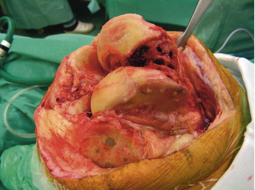 Figure 2. After removal of femoral and patellar components.