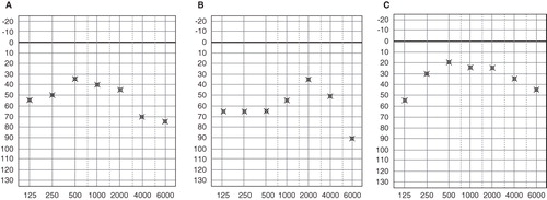 Figure 5. Warble tone threshold level. Compared with the threshold level of the conventional hearing aid (A), the threshold level of the VSB at the first fitting was improved at the high frequencies (B). After refitting, amplification at the low frequencies was elevated (C).